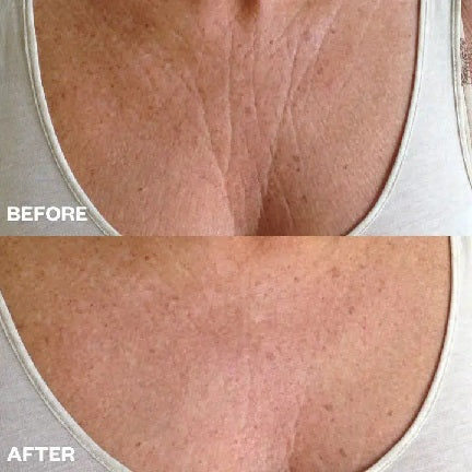 Reusable Silicone Chest Wrinkle Patches